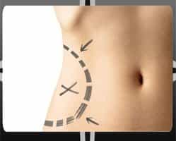 Tummy Tuck Procedure