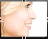 Best Rhinoplasty Procedure