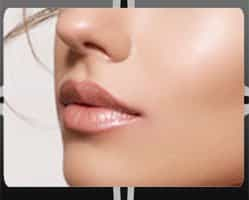 Lip Augmentation