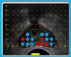 Prostate Cancer Screening, Frankfurt, Germany