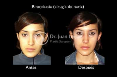 Rhinoplasty Surgery in Mexico