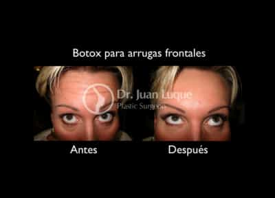 Botox in Mexicali