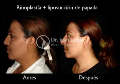 Rhinoplasty in Mexicali