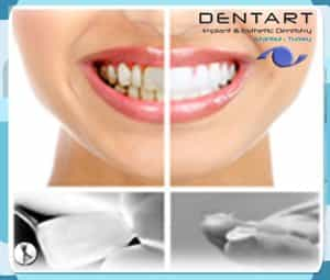 Lumineers Veneers in Istanbul Turkey at Dentart