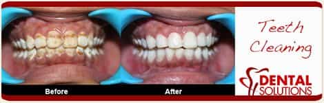 Before and After Teeth Cleaning in India Bangalore