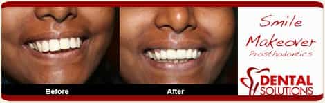 Before and After Smile Makeover in India Bangalore