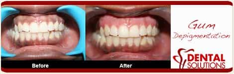 Before and After Gum Depigmentation Treatment in India Bangalore