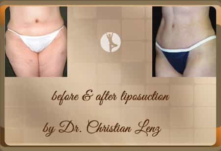 Before and after liposuction in germany