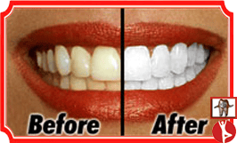 Teeth Whitening Bangalore India