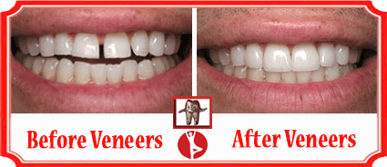 Cosmetic Dentistry Bangalore