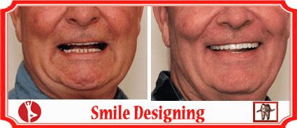 Teeth Whitening Bangalore India