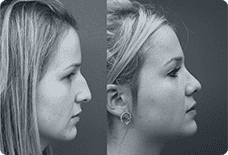Before And After Rhinoplasty Istanbul