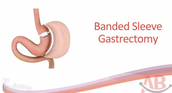 Banded Sleeve Gastrectomy at Asian Bariatrics India Ahemdabad