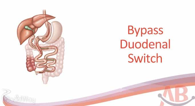 Bypass Duodenal Switch at Asian Bariatrics India, Ahemdabad
