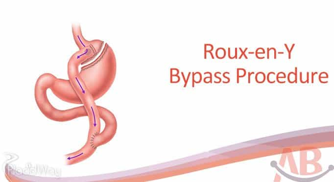 Roux-en-Y-Obesity Surgery at Asian Bariatrics India Ahmedabad