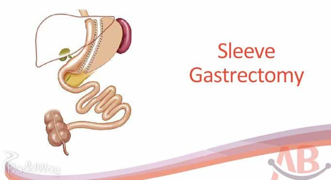 Sleeve Gastrectomy at Asian Bariatrics India, Ahemdabad