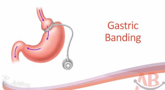 Adjustable Gastric Band by Asian Baritarics India Ahmedabad