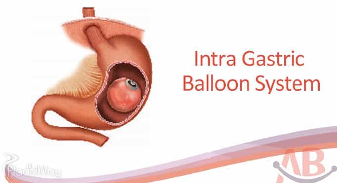 Intra Gastric Baloon System Bariatric Surgery Ahmedabad India