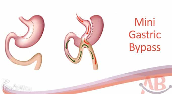 Mini Gastric Bypass in Ahmedabad Asian Bariatrics