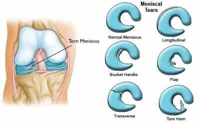 Meniscus Tear Reapair Mexico