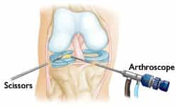 Knee Arthroscopy Mexico