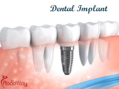 Dental lmplant Treatment