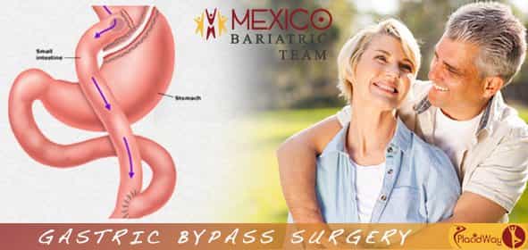 mexico bariatric team obesity clinic gastric bypass surgery in mexicali image