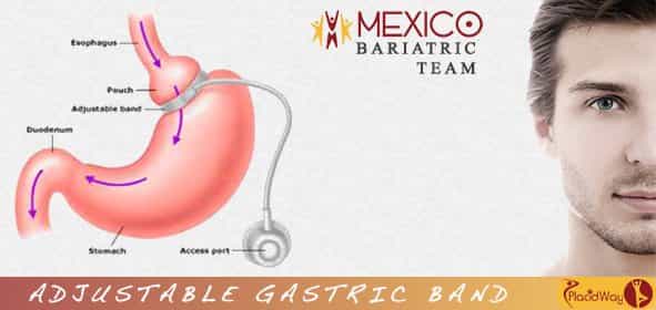 mexico bariatric team obesity clinic adjustable gastric band mexicali image