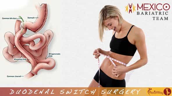 mexico bariatric team obesity clinic duodenal switch mexicali image