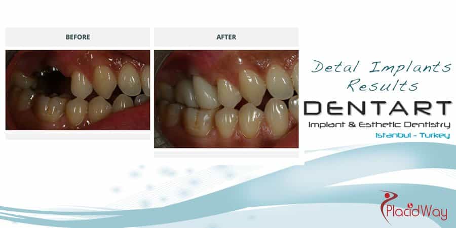 Dental implants before and After in Turkey