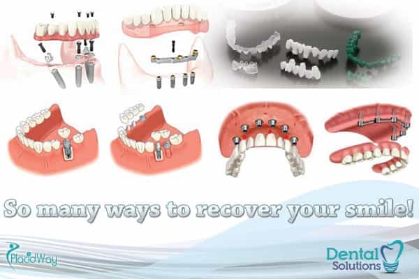 dental-solutions-los-algodones-dentistry work-in-mexico-images-implants