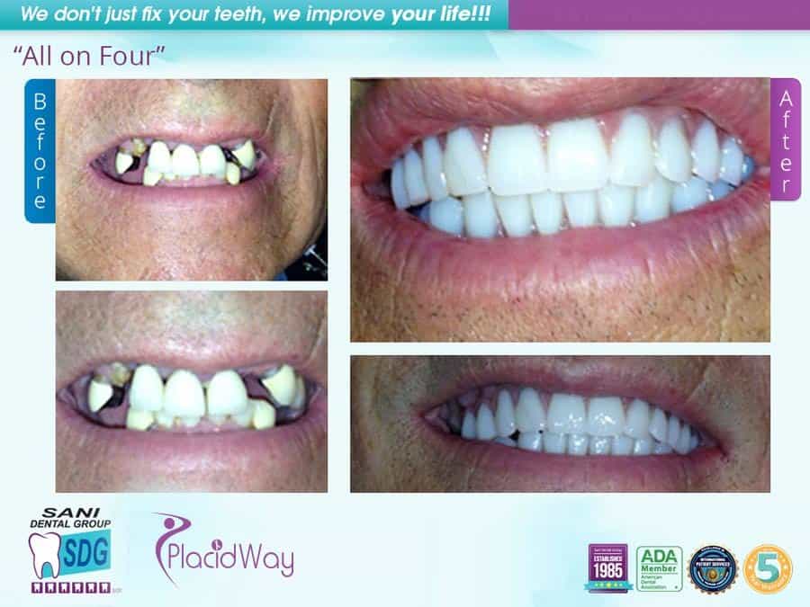 All on 4 Dental Implants Mexico Before and After