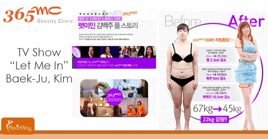 Before and After Surgery - Liposuction Clinic - Seoul, South Korea