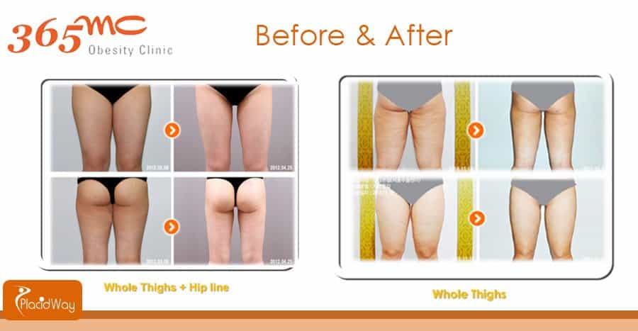Before and After Whole Thighs Liposuction - South Korea