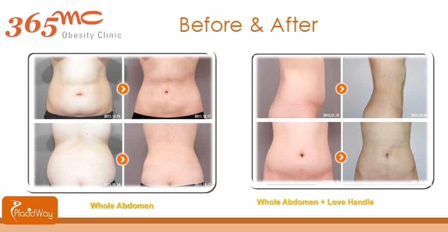 Before and After Whole Abdomen Liposuction - South Korea