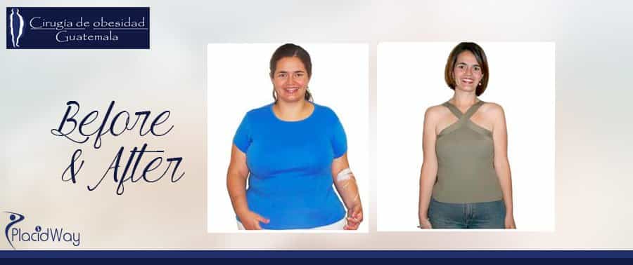 Before  & After Obesity Surgery - Guatemala