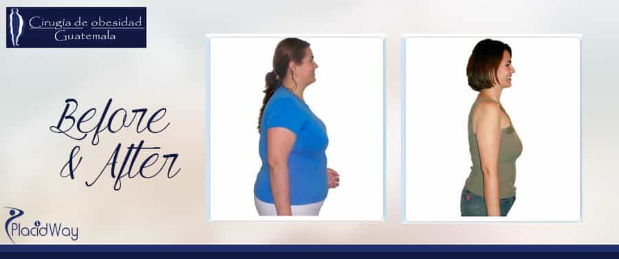 Before and After Bariatric Surgery - Guatemala