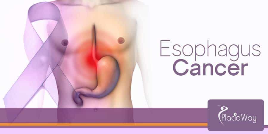 Esophagus Cancer Treatment Overview