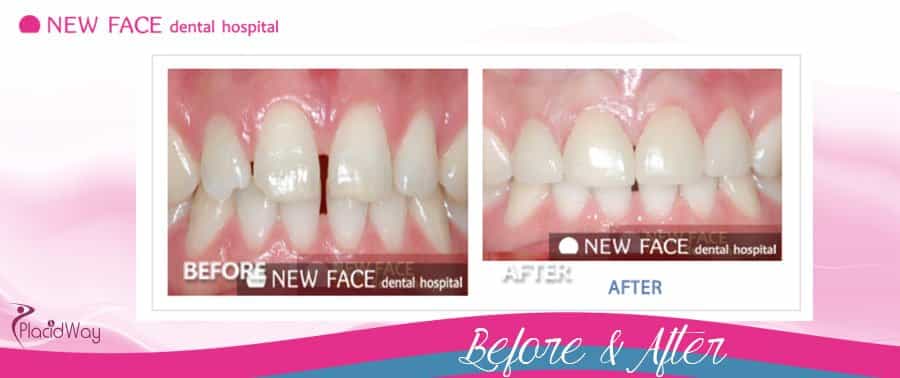 Before & After Total Esthetics Dental Treatment Seoul