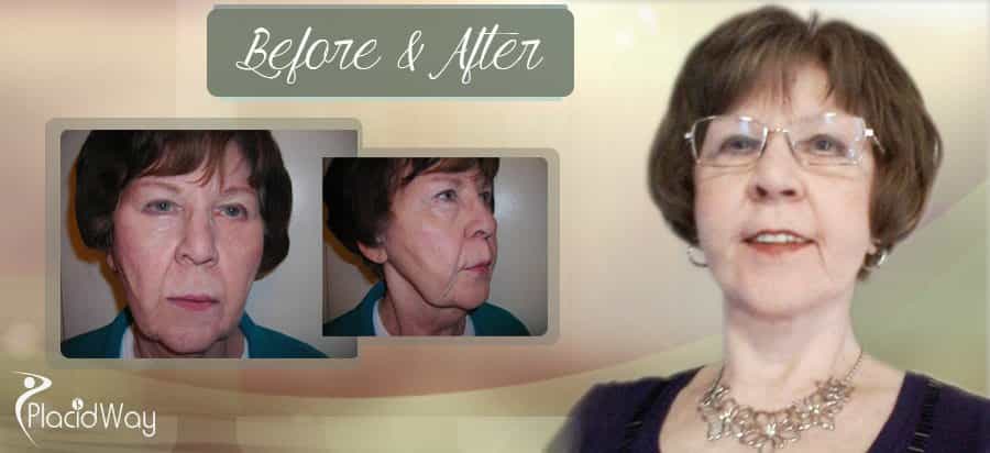 Before & After Face Lift Patient Result Mexico