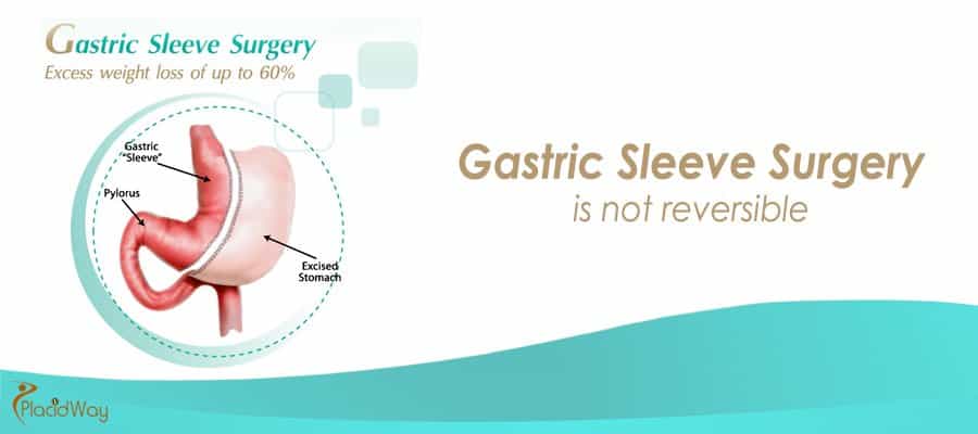 Gastric Sleeve Surgery