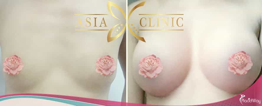 Breast Augmentation Thailand, Cosmetic Surgery Asia