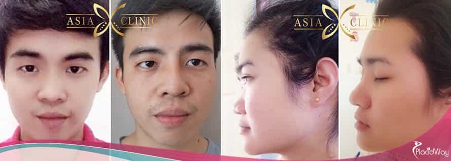 Nose Surgery Thailand, Cosmetic Procedures