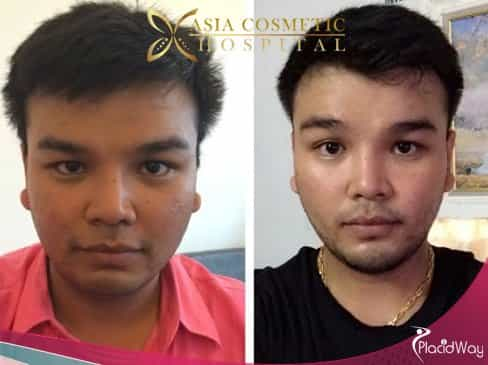 Male Chin Augmentation, Chin Surgery