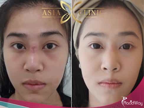 Scar Removal Surgery, Cosmetic Surgery Thailand