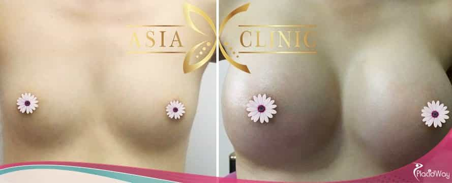 Breast Augmentation