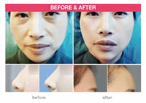 Dermal Filler, Skin Treatment, Seoul, South Korea