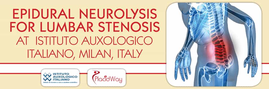 Epidural-Neurolysis-for-Lumbar-Stenosis-at-Istituto-Auxologico-Italy