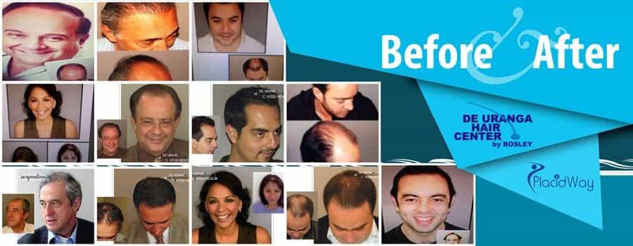 Hair Transplantation Before and After, Mexico City, Mexico