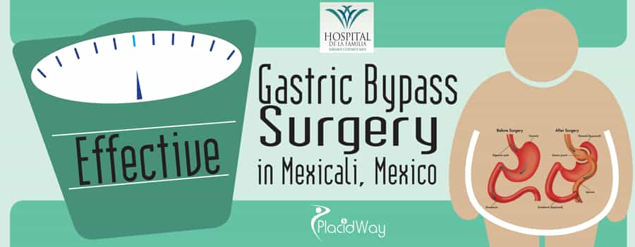 Effective Gastric Bypass Surgery in Mexicali, Mexico